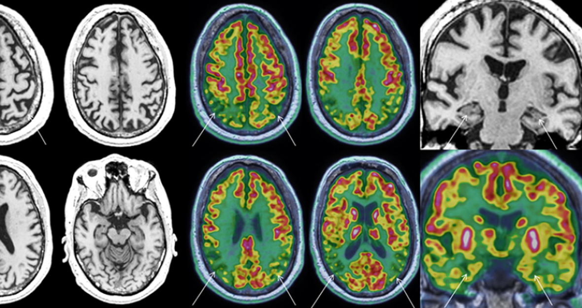 LA NEURO IMAGERIE PLUS QUUN SIMPLE OUTIL DE CARTOGRAPHIE VERS UN